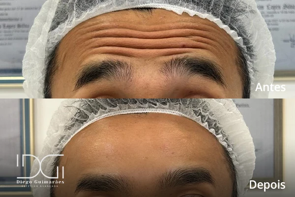 Harmonização facial masculina em Curitiba