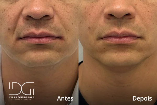 Preenchimento facial em Curitiba