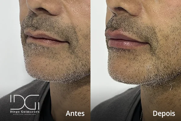 preenchimento labial masculino em Curitiba