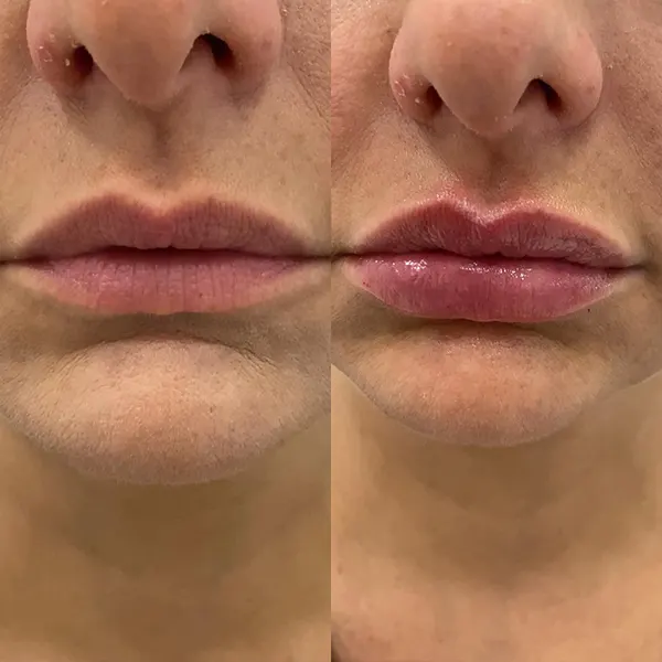 harmonização facial