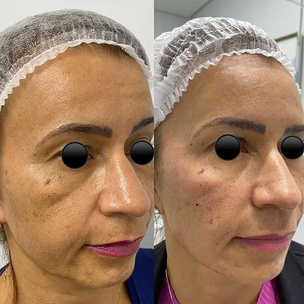 harmonização facial