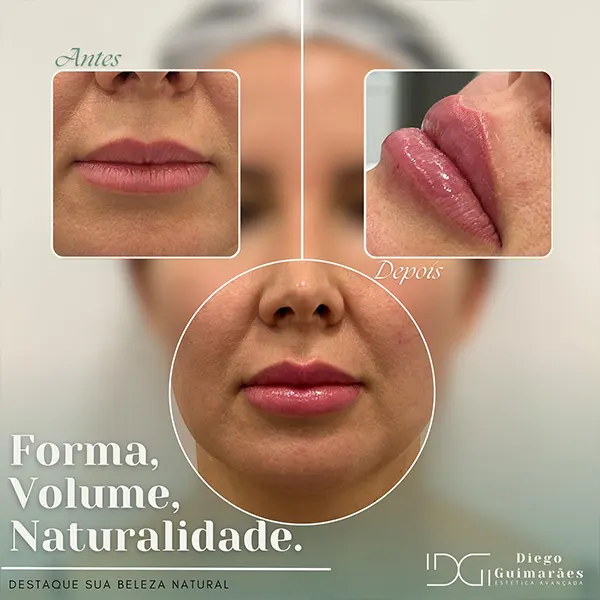 harmonização facial