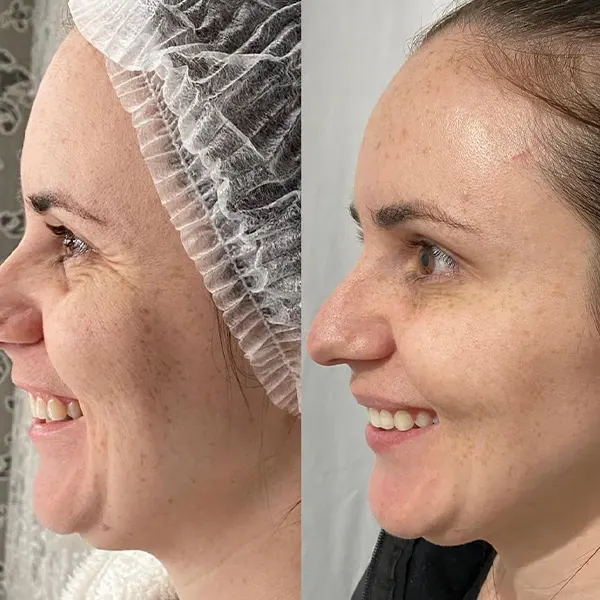 harmonização facial